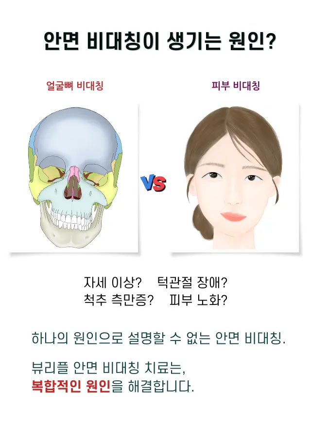 압구정 뷰리플한의원 안면 비대칭이 생기는 원인