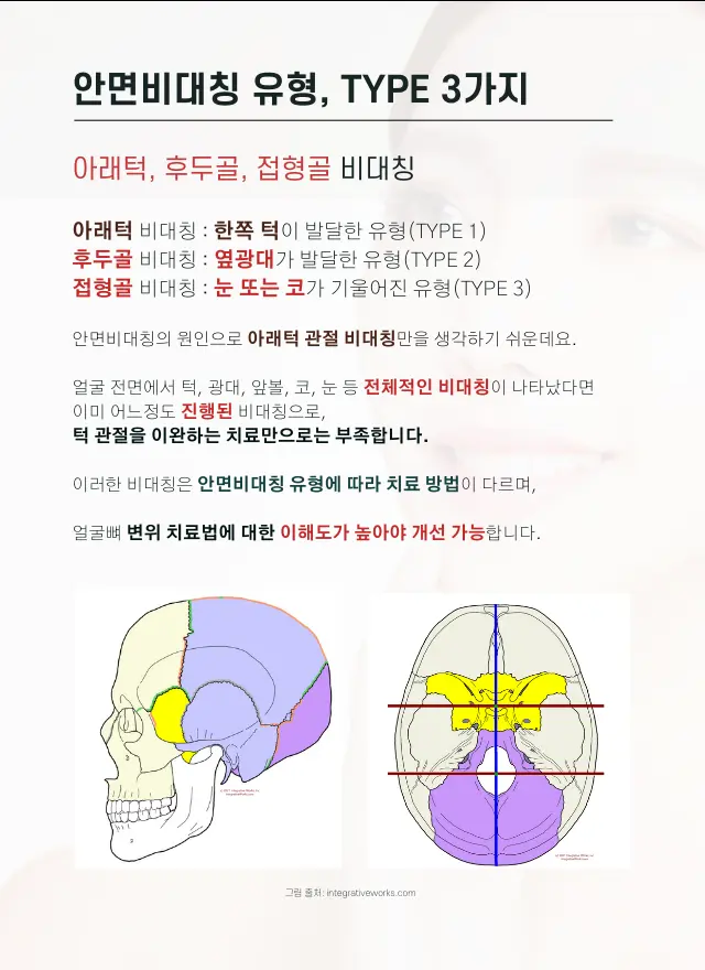 압구정 뷰리플한의원 안면비대칭 변위 유형