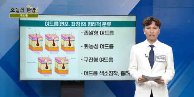 압구정 뷰리플한의원 오늘의 한방 여드름 - 1